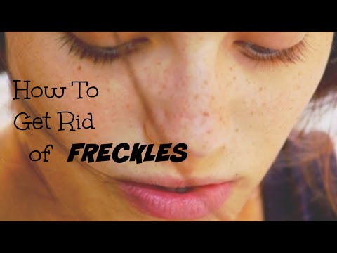 How to Get Rid of Freckles