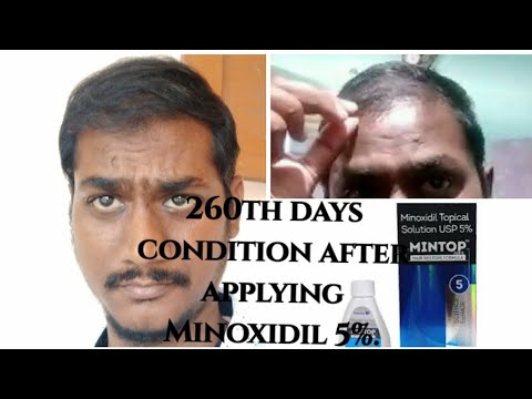Minoxidil Topical Solution