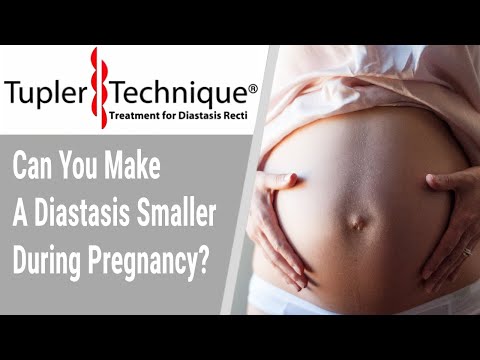 Can You Make A Diastasis Smaller During Pregnancy