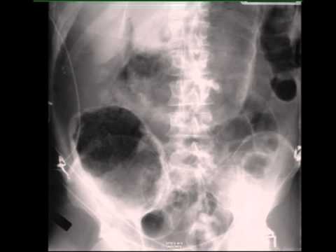 Large Pneumoperitoneum on Abdominal X ray