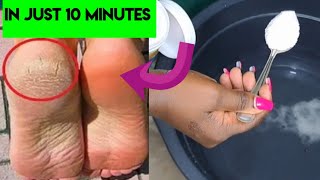 In Just 10 Mins - Get Rid of CRACKED HEELS permanently || How to remove dead skin at home naturally