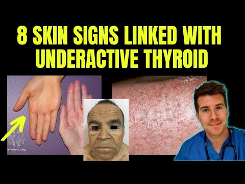 Doctor explains 8 SKIN SIGNS linked with HYPOTHYROIDISM (aka underactive thyroid)