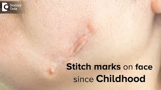 Stitch marks on face since Childhood. How to reduce this? - Dr. Rasya Dixit | Doctors