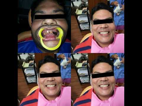 Braces & Smile Designing