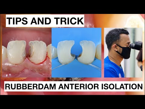 Tips and Trick Rubberdam Anterior Isolation