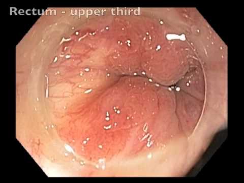 Anal canal - Cancer - Healed after chemoradiation