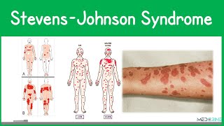Stevens-Johnson Syndrome: Causes, Diagnosis, Differentials, Symptoms and Treatment