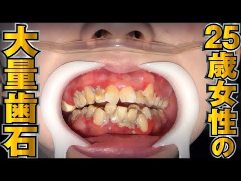25歳女性の大量歯石[Remove tartar]歯石除去Vol.10(牙石去除)