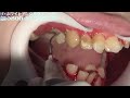 zubny kamen po chemoterapii (nemam) - Známka: 4, váha: malá
