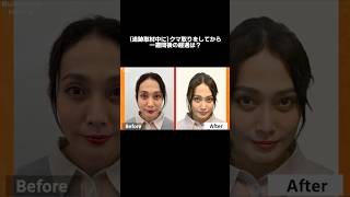 【クマ取り】追跡取材中に施術を行なってから1週間が経ちました#shorts