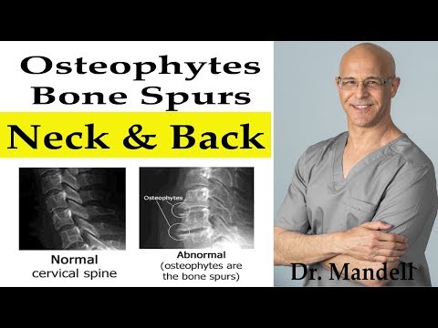 Do Bone Spurs/Osteophytes in Neck & Back Go Away? -  Dr Alan Mandell, DC