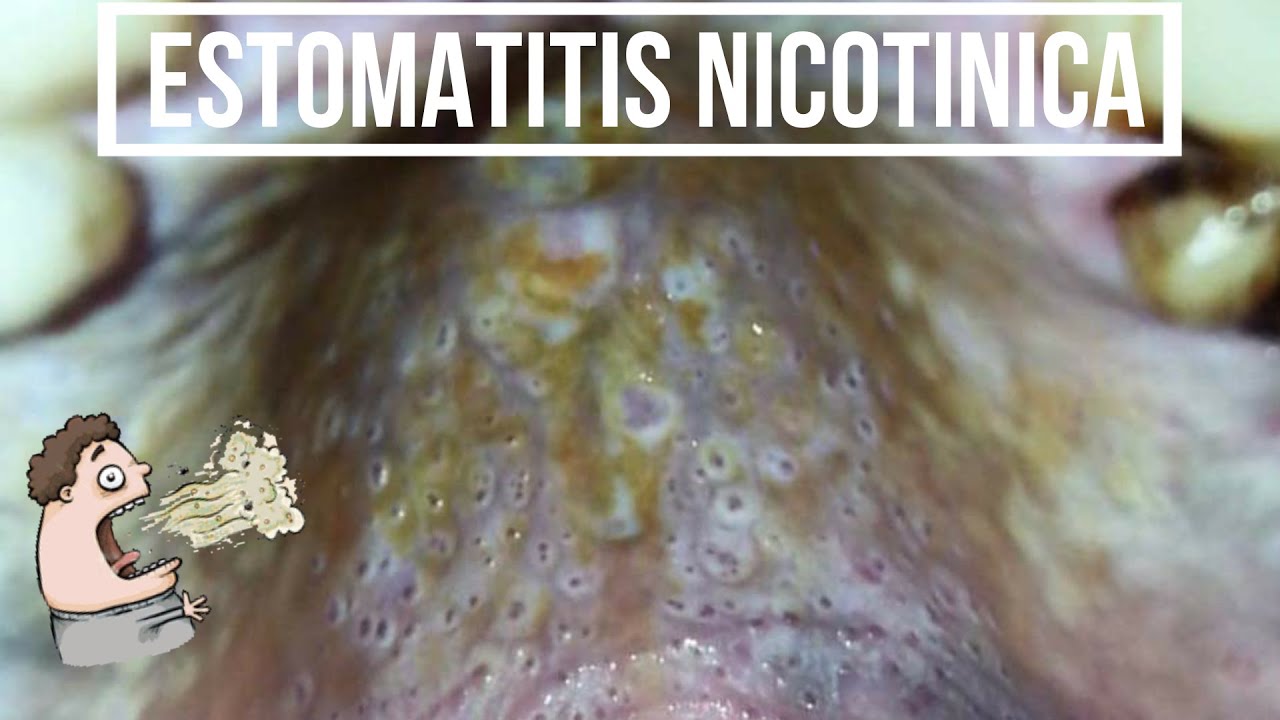 ESTOMATITIS NICOTÍNICA - Paladar del fumador, Hiperqueratosis DE LA MUCOSA DEL PALADAR. Odontología.