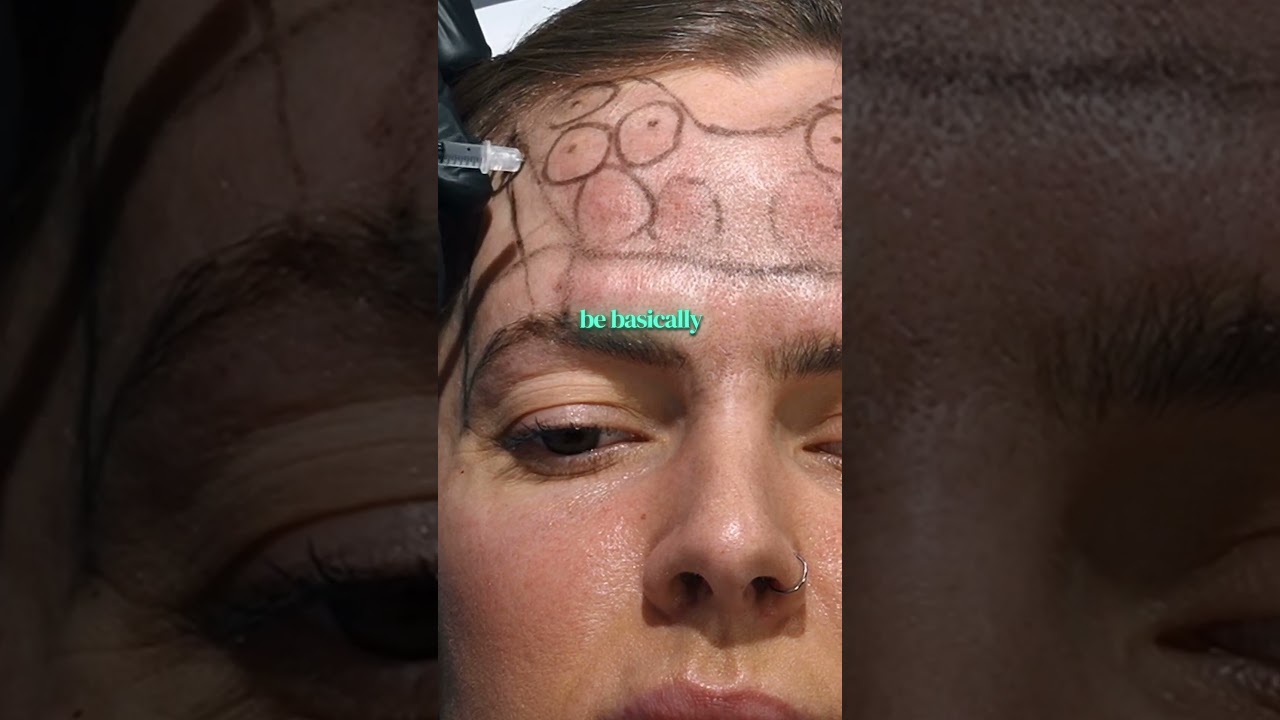 Injection points for the forehead