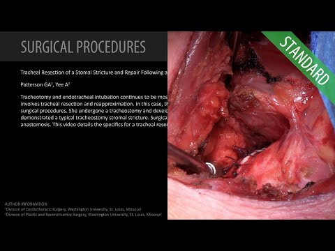 Tracheal Resection of a Stomal Stricture and Repair - Standard (Feat. Dr. Patterson)