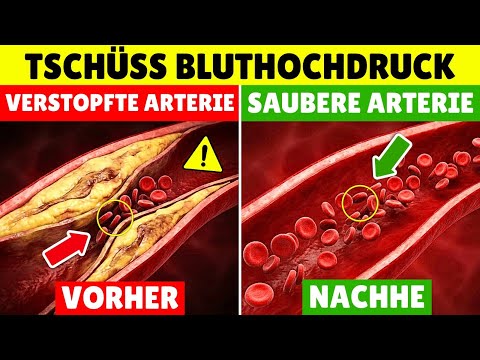 Wenn Du HOHEN BLUTDRUCK Hast, Iss Dies: Reinigt Arterien Und Cholesterin
