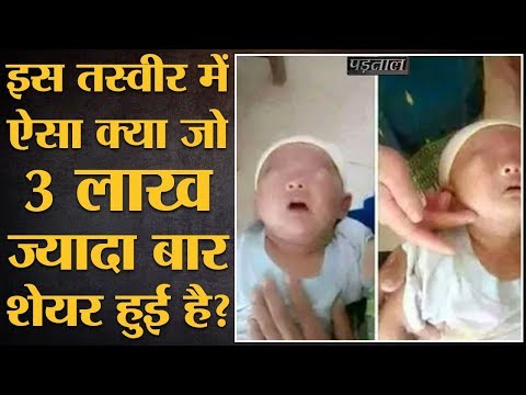 कुछ साल पुरानी तस्वीर में दिख रहे बच्चे को दुर्लभ रोग Cryptophthalmos हुआ है | The Lallantop