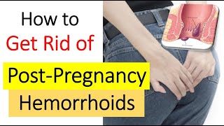 3 Steps to Getting Rid of POSTPARTUM HEMORRHOIDS | Hemorrhoids After Pregnancy Not Going Away?
