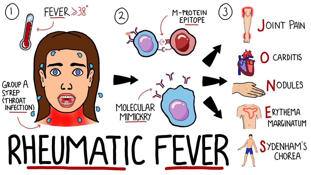 Rheumatic Fever Made Easy (Including Jones Criteria and Mnemonic!)
