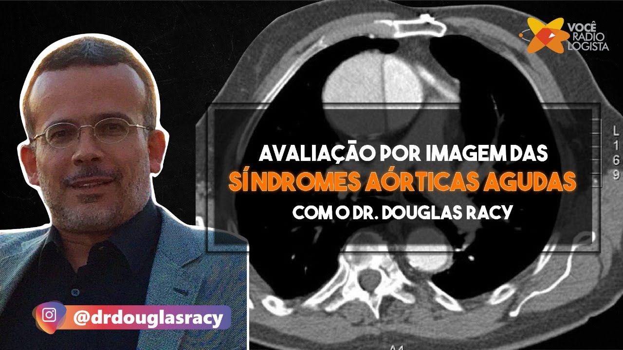 Síndromes Aórticas Agudas: o que você precisa saber? Com Dr Douglas Racy