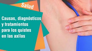 Salud | ¿Qué hacer si detectamos un bulto en la axila