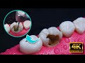 AMAZING reconstruction of tooth damaged by caries: Endodontics