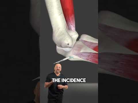 Tommy John Elbow Surgery & Faster Pitching #elbowsurgery #tommyjohn #baseballinjury