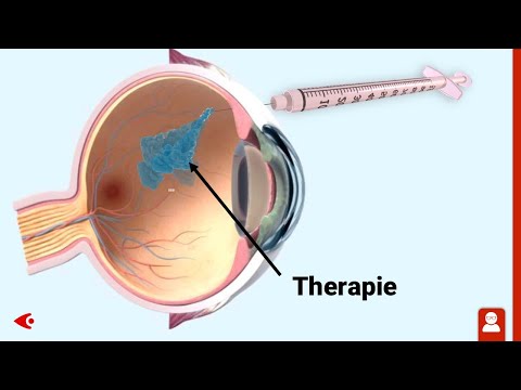 IVOM Injektion: Animation