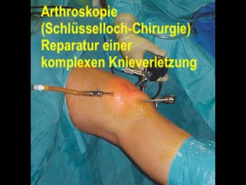 Arthroskopie schwere Knieverletzung (Knorpelschaden, Mensicusri,  Plicasyndrom)