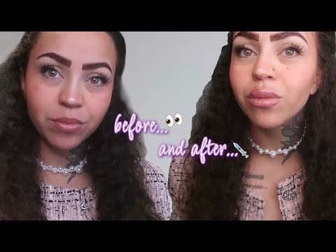 lip filler vlog 🤍 what i'd tell first-timers