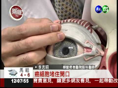 皮脂癌誤當針眼 延誤就醫險沒命!