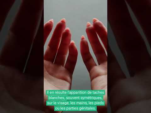 Vidéo : vitiligo — taches blanches, causes et traitements