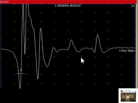 SFEMG - Neurogenic blocking  (Erik Stalberg)