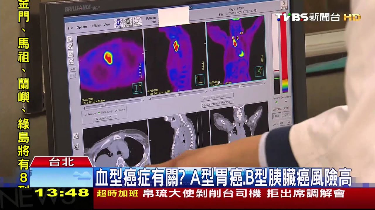 ​血型癌症有關？　A型胃癌、B型胰臟癌風險高