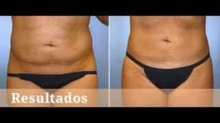 Abdominoplastia Dr José María Jiménez