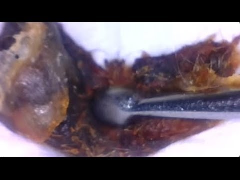 Massive Ear Wax Removal This DJ Can Hear Again! 🎵