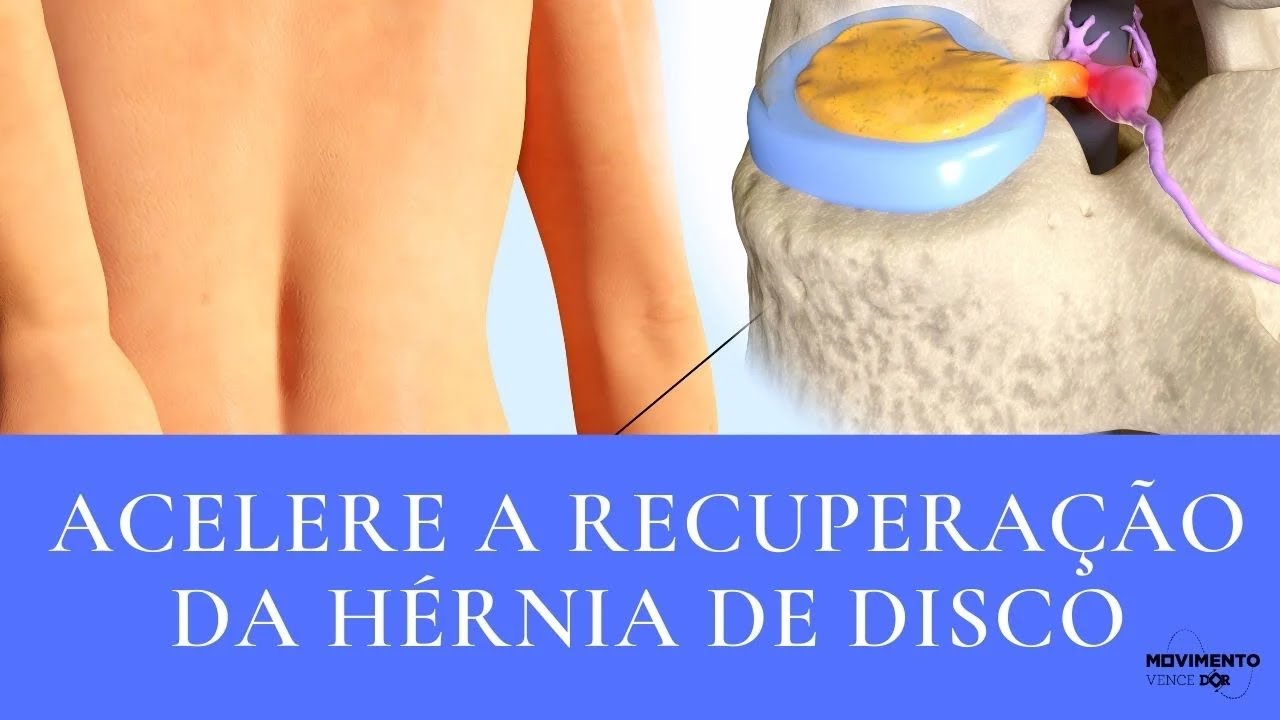 3 Providências Imediatas para quem tem Hérnia de Disco | Acelere a recuperação!