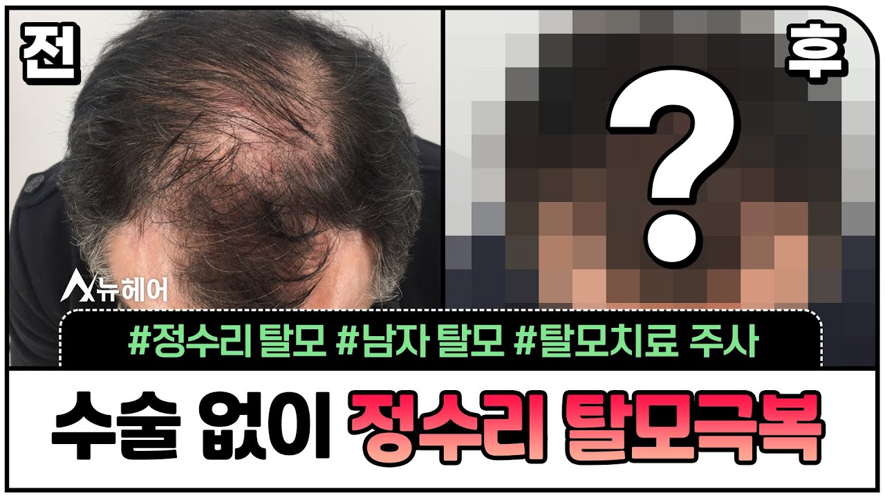 정수리탈모 때문에 수술 없이 '이 치료'를 했는데...ㅣ뉴헤어