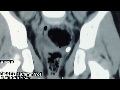 URS laser lithoclast @Pediatric-Urologist