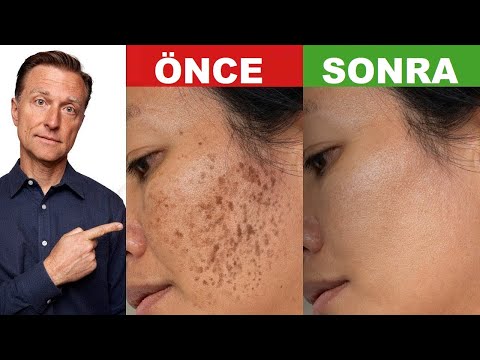 OP DR ELİF SEDA KESKİN Leke Tedavisi Anlatıyor I TV8 ÇOOK YAŞA I Cosmelan