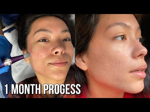 Best way to remove acne scars? Microneedling Session #2