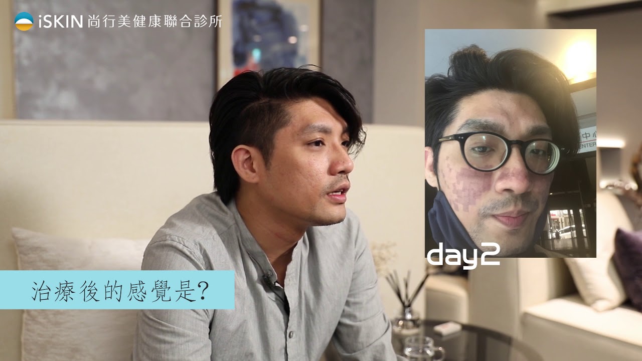 【iSKIN尚行美健康聯合診所-盧靜怡醫療團隊】-多層次痘疤治療-痘疤界的金城武小東