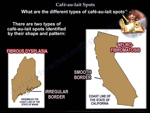 Cafe-au-lait Spots- Everything You Need To Know - Dr. Nabil Ebraheim