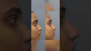 "The Future of Nose Reshaping: 5 Facts About Non-Surgical Rhinoplasty!"