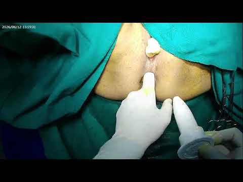Bilateral MOLIS for severe anal canal stenosis operative video