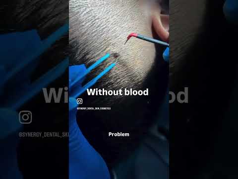 Mole Removal Treatment | Dr. Dipali Dambal