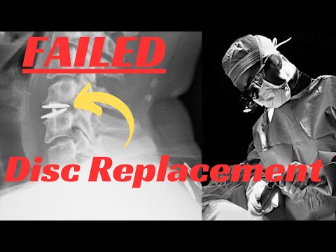Failed disc replacement: How I fixed it.