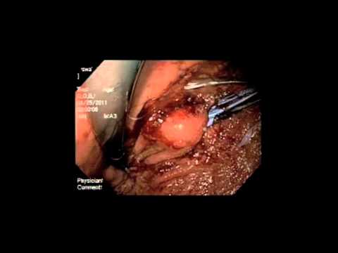 Laparoskopowa resekcja guza stromalnego żołądka