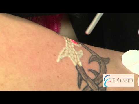 Tatuoinnin poisto laserilla