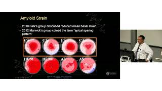 Cardiac Amyloid – Prof Greg Scalia