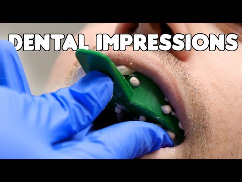 YouTube video about: How long do orthodontist keep retainer molds?